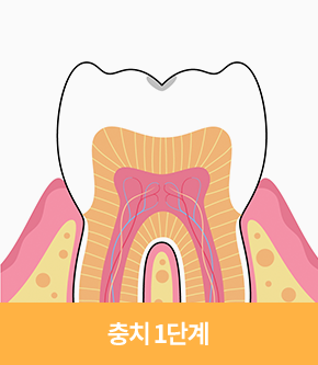 충치 1단계