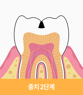 충치 2단계