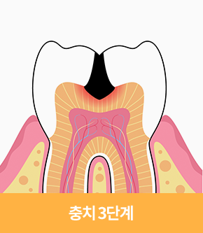 충치 3단계