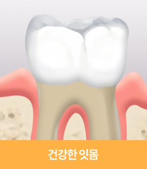 건강한 잇몸