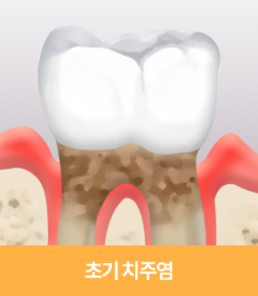 초기 치주염