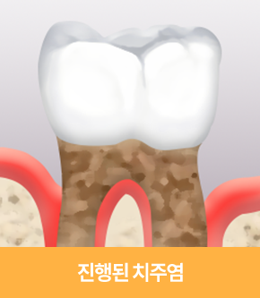 진행된 치주염