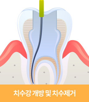 치수강 개방 및 치수제거