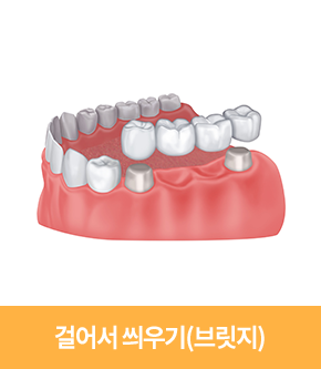 걸어서 씌우기(브릿지)