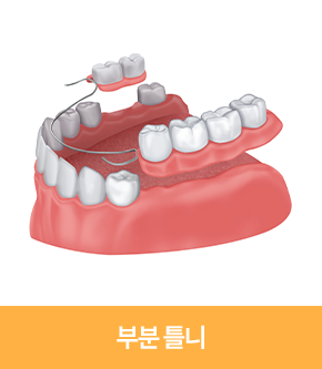 부분 틀니