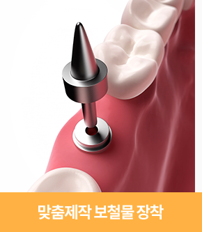 맞춤제작 보철물 장착