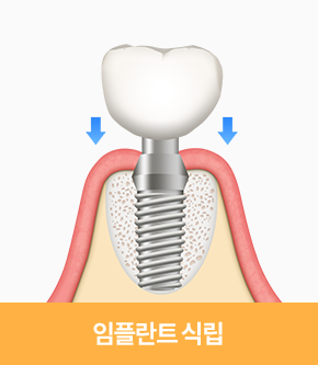 임플란트 식립