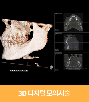 3D 디지털 모의시술